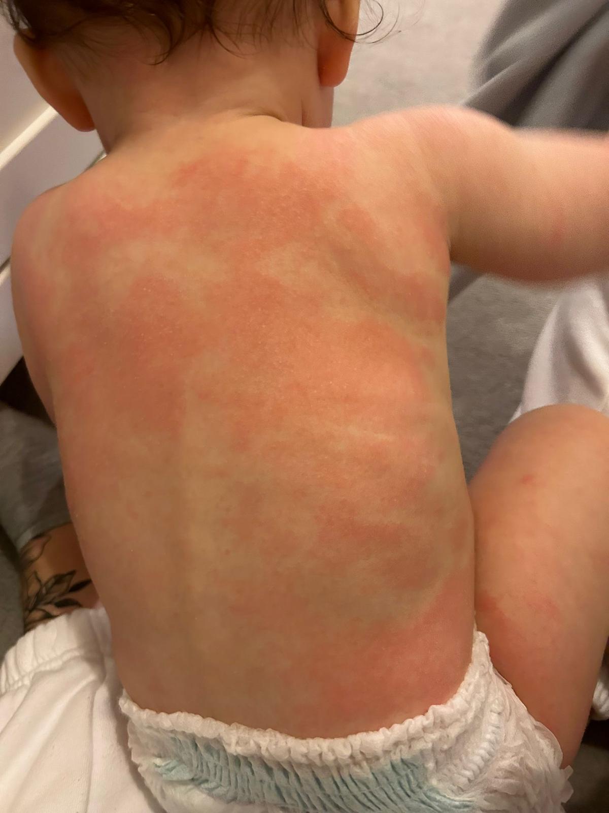 Navigating the Journey through Children's Eczema, Atopic Dermatitis, and Psoriasis