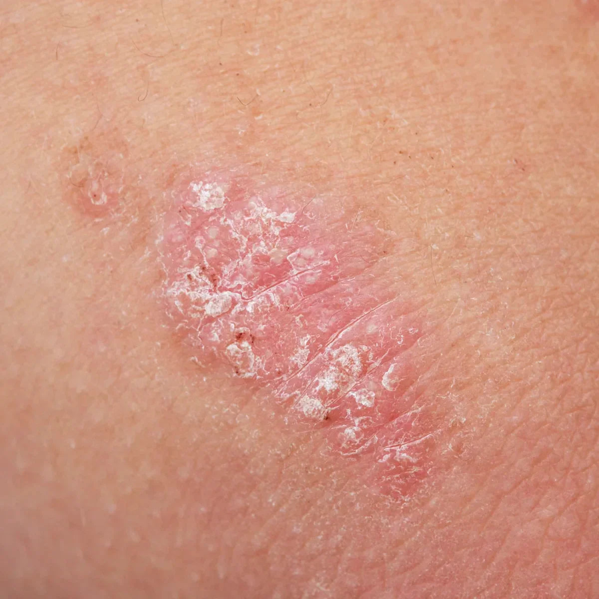 Eczema, Dermatitis & Psoriasis: What's the Difference?